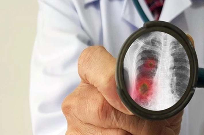 Penyakit Pneumonia 'Misterius' Muncul, Kemenkes: ‘Dapat Menimbulkan Kejadian Luar Biasa’