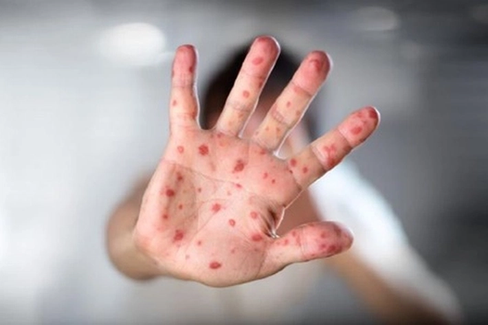 Prof Hinky Hindra Irawan Satari Nilai Virus Campak Meningkat Lagi, 'bisa Bertahan Lebih Lama di Udara dan Mudah Menular'