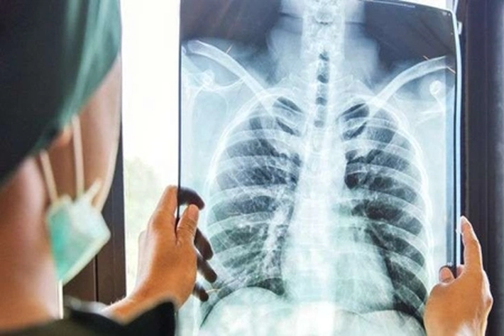 Batuk tak Kunjung Sembuh Segera Periksakan ke Dokter, 'Bisa jadi Tanda Gejala Kanker Paru'