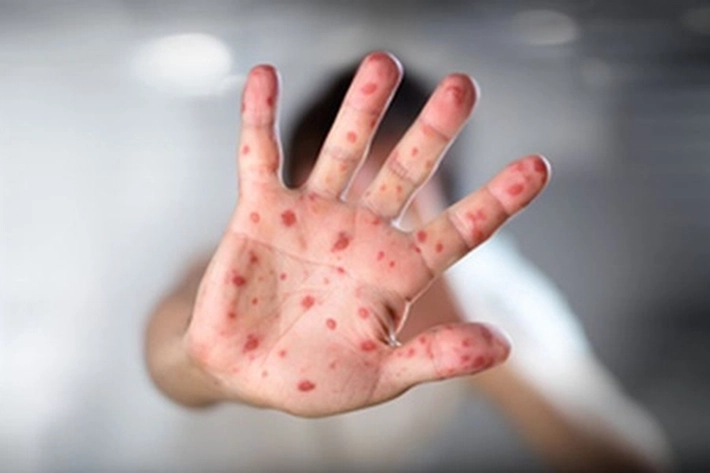 Penyakit Mirip Gejala Flu Asal Singapura Ditemukan di Batam, Diskes: Ada Ruam-ruam Ditelapak Kaki-Tangan Serta Sariawan pada Mulut Penderita